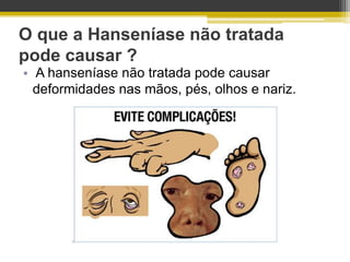 O que a Hanseníase não tratada
pode causar ?
• A hanseníase não tratada pode causar
  deformidades nas mãos, pés, olhos e nariz.
 