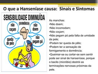 O que a Hanseníase causa: Sinais e Sintomas

                     As manchas:
                     •Não doem;
                     •Não incomodam;
                     •Não coçam;
                     •Não pegam pó pela falta de umidade
                     da pele;
                     •Podem ter queda de pêlo;
                     •Podem ter a sensação de
                     formigamento e dormência;
                     •Queimar-se ou cortar-se sem sentir
                     pode ser sinal de hanseníase, porque
                     o bacilo (micróbio) destrói as
                     terminações nervosas próximas da
                     pele.
 