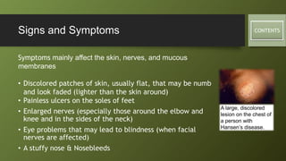 Hansen Images Hansen’s disease (leprosy) | PPTX