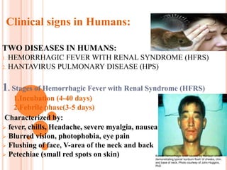 Hantavirus as an emerging disease | PPTX