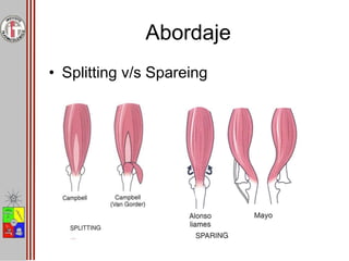 Abordaje
• Splitting v/s Spareing
 