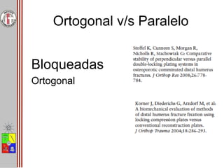 Ortogonal v/s Paralelo
Bloqueadas
Ortogonal
 