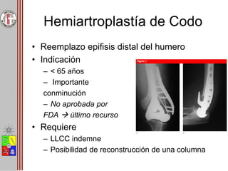 Hemiartroplastía de Codo
• Reemplazo epifisis distal del humero
• Indicación
– < 65 años
– Importante
conminución
– No aprobada por
FDA  último recurso
• Requiere
– LLCC indemne
– Posibilidad de reconstrucción de una columna
 