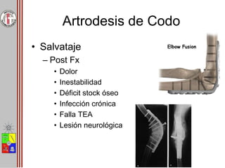 Artrodesis de Codo
• Salvataje
– Post Fx
• Dolor
• Inestabilidad
• Déficit stock óseo
• Infección crónica
• Falla TEA
• Lesión neurológica
 