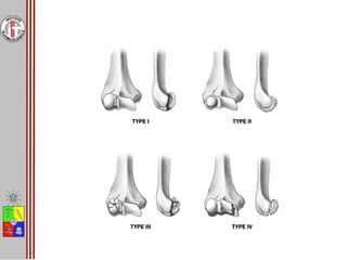 Fractura Húmero Distal