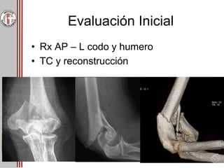 Evaluación Inicial
• Rx AP – L codo y humero
• TC y reconstrucción
 