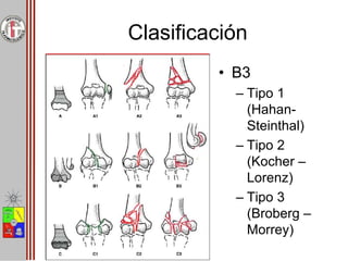 Clasificación
• B3
– Tipo 1
(Hahan-
Steinthal)
– Tipo 2
(Kocher –
Lorenz)
– Tipo 3
(Broberg –
Morrey)
 