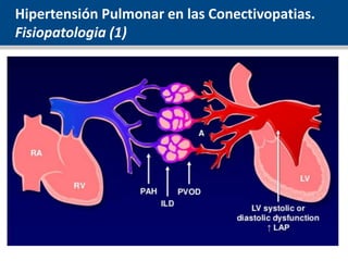 Hipertensión Pulmonar en las Conectivopatias.
Fisiopatologia (1)
 