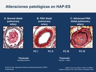 Alteraciones patológicas en HAP-ES
A. Normal distal
pulmonary
artery
B. PAH distal
pulmonary
artery
C. Advanced PAH
distal...