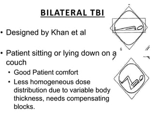 BILATERAL TBI
• Designed by Khan et al
• Patient sitting or lying down on a
couch
• Good Patient comfort
• Less homogeneous dose
distribution due to variable body
thickness, needs compensating
blocks.
 