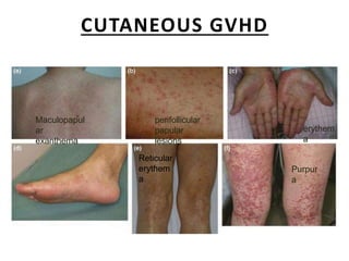 CUTANEOUS GVHD
Maculopapul
ar
exanthema
perifollicular
papular
lesions
erythem
a
Purpur
a
Reticular
erythem
a
 