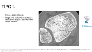 Haraguchi Tibia Clasificación de Haraguchi para fracturas de maleolo posterior.pptx
