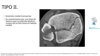 Haraguchi Tibia Clasificación de Haraguchi para fracturas de maleolo posterior.pptx
