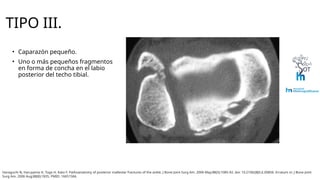 Haraguchi Tibia Clasificación de Haraguchi para fracturas de maleolo posterior.pptx
