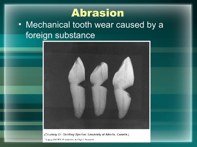 Hard Tissue Charting | PPT | Dental Health | Diseases and Conditions