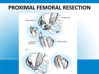 PROXIMAL FEMORAL RESECTION
 
