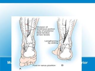 Musculotendinous Recession of the Posterior
Tibial Tendon
 