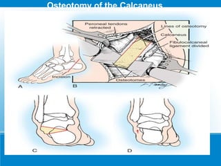 Osteotomy of the Calcaneus
 