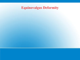 Equinovalgus Deformity
 