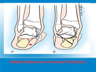 Medial Displacement Calcaneal Osteotomy
 