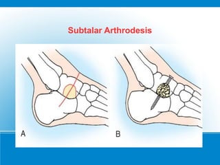 Subtalar Arthrodesis
 