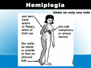 Hemiplegia
limbs on only one side
 