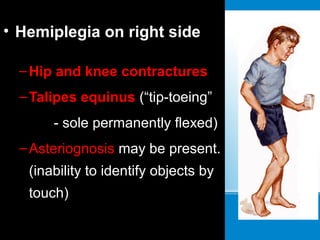 • Hemiplegia on right side
–Hip and knee contractures
–Talipes equinus (“tip-toeing”
- sole permanently flexed)
–Asteriognosis may be present.
(inability to identify objects by
touch)
 