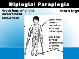 Diplegia/ Paraplegia
•both legs•both legs w/ slight
involvement
elsewhere
 