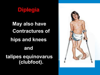 Diplegia
May also have
Contractures of
hips and knees
and
talipes equinovarus
(clubfoot).
 