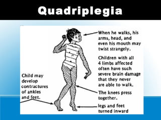 Quadriplegia
 