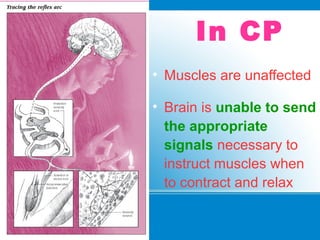 In CP
• Muscles are unaffected
• Brain is unable to send
the appropriate
signals necessary to
instruct muscles when
to contract and relax
 