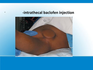 •
-intrathecal baclofen injection
 