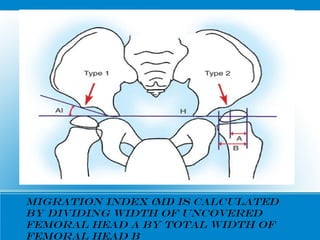 Migration index (MI) is calculated
by dividing width of uncovered
femoral head A by total width of
femoral head B
 