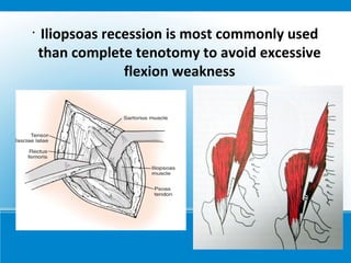 •
Iliopsoas recession is most commonly used
than complete tenotomy to avoid excessive
flexion weakness
 