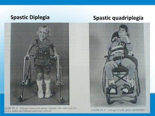 Spastic Diplegia Spastic quadriplegia
 