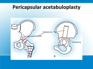 Pericapsular acetabuloplasty
 