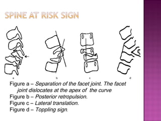 Toppling Sign tuberculosis of spine | PPT