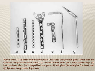 Bone Plates: (a) dynamic compression plate, (b) hybrid compression plate (lower part has
dynamic compression screw holes), (c) reconstruction bone plate (easy contouring), (d)
buttress bone plate, (e) L shaped buttress plate, (f) nail plate (for condylar fracture), and
(g) dynamic compression hip screw.
 