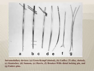 Intramedullary devices: (a) Gross-Kempf (slotted), (b) Uniflex (Ti alloy, slotted),
(c) Kuntscher, (d) Samson, (e) Harris, (f) Brooker-Wills distal locking pin, and
(g) Enders pins.
 