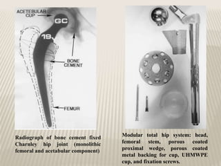 Modular total hip system: head,
femoral stem, porous coated
proximal wedge, porous coated
metal backing for cup, UHMWPE
cup, and fixation screws.
Radiograph of bone cement fixed
Charnley hip joint (monolithic
femoral and acetabular component)
 