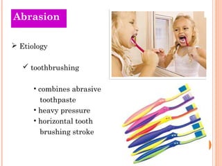 Abrasion

 Etiology

    toothbrushing

      • combines abrasive
        toothpaste
      • heavy pressure
      • hori...