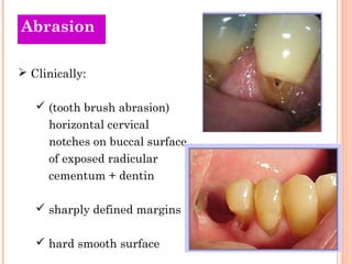 Abrasion

 Clinically:

    (tooth brush abrasion)
     horizontal cervical
     notches on buccal surface
     of expos...