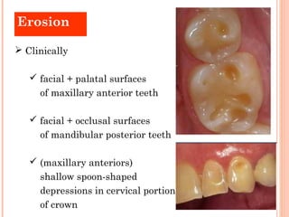 Erosion

 Clinically

    facial + palatal surfaces
     of maxillary anterior teeth

    facial + occlusal surfaces
  ...