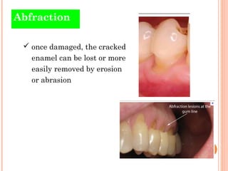 Abfraction

  once damaged, the cracked
   enamel can be lost or more
   easily removed by erosion
   or abrasion
 
