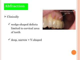 Abfraction

 Clinically

    wedge-shaped defects
     limited to cervical area
     of teeth

    deep, narrow + V-sha...