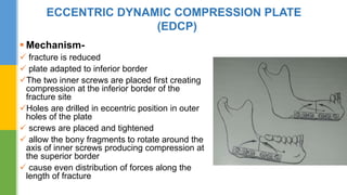 Hardware in maxillofacial trauma | PPTX