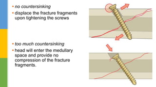 Hardware in maxillofacial trauma | PPTX