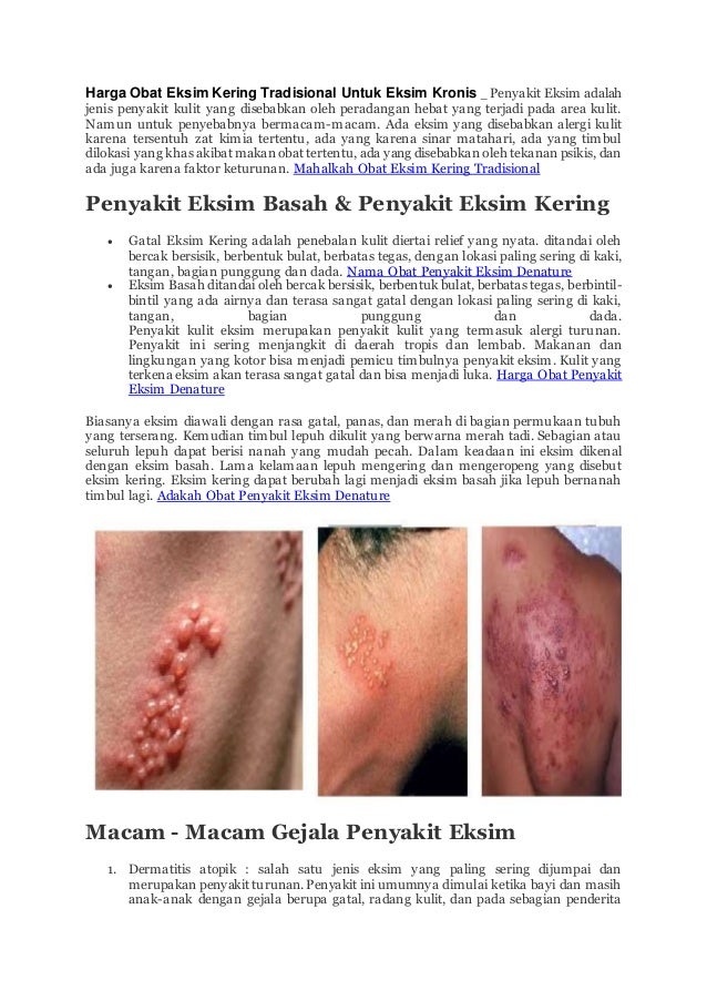 Harga obat eksim kering tradisional untuk eksim kronis
