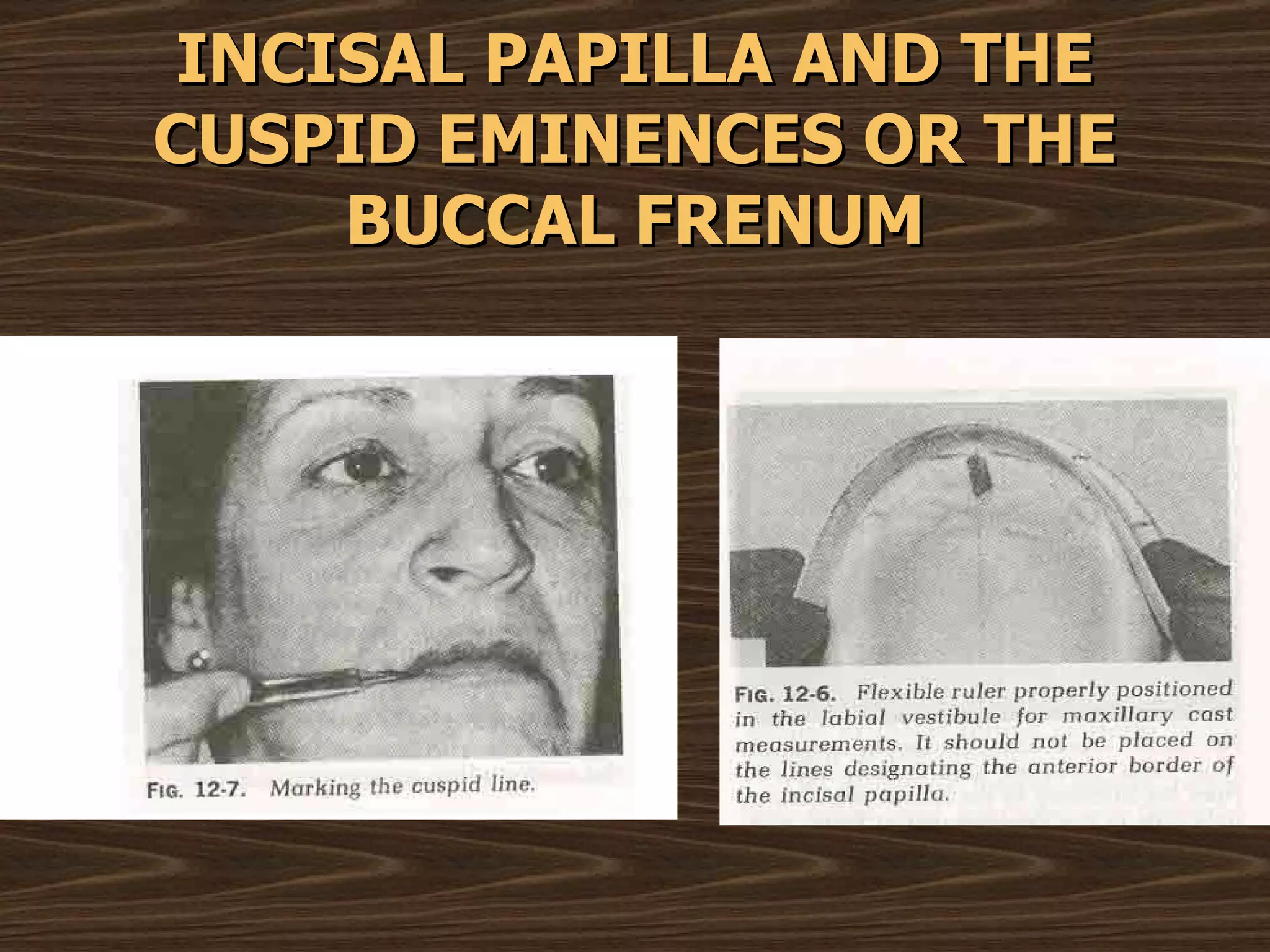 INCISAL PAPILLA AND THE CUSPID EMINENCES OR THE BUCCAL FRENUM 