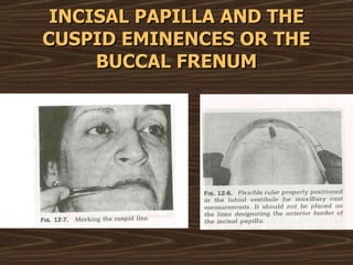 INCISAL PAPILLA AND THE CUSPID EMINENCES OR THE BUCCAL FRENUM 
